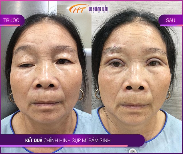 Kết quả sửa sụp mí tại Thẩm mỹ Hoàng Tuấn